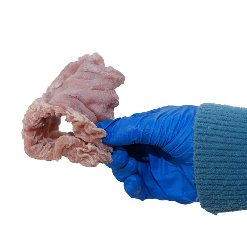 Simulated Ulcerative Gastric Cancer Model Simulated Ulcerative Gastric Cancer Model